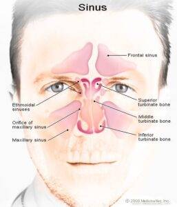 Sinusitis