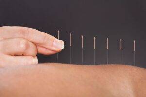 Acupuncture Near Me - Acupuncture and Dry Needling