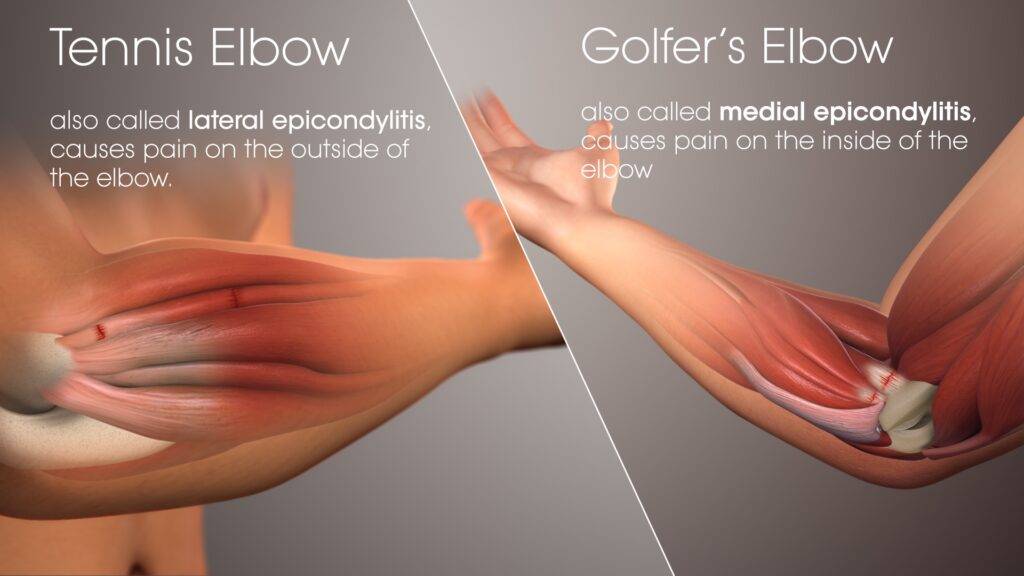 Golfer’s Elbow/Tennis Elbow