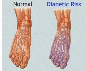 Nerve Pain cause